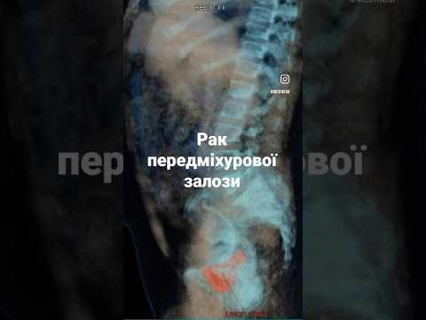 Рак передміхурової залози