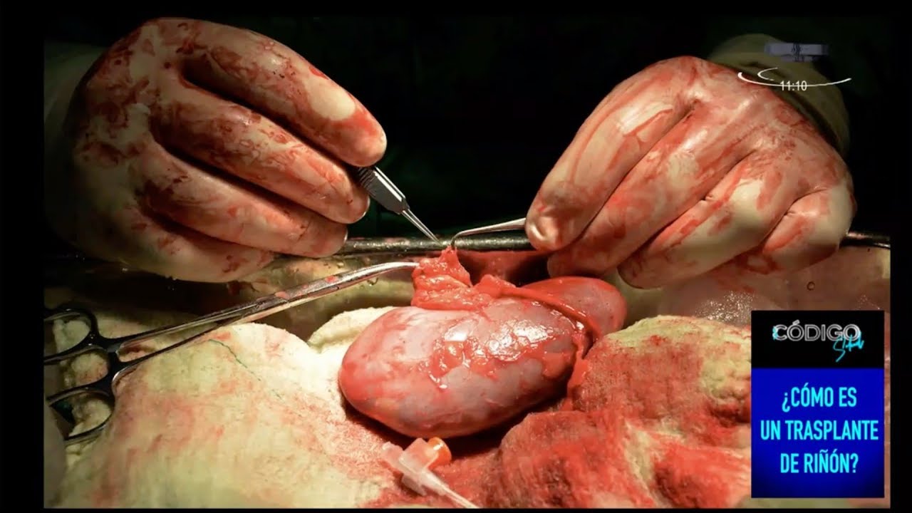 Cuál es el tiempo de vida que otorga un trasplante de riñón