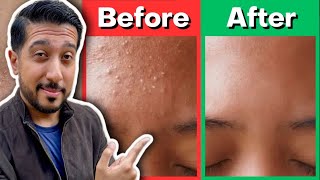 How to Rid Fungal Acne | Fungal Acne Treatment THAT WORKS for Malassezia Folliculitis