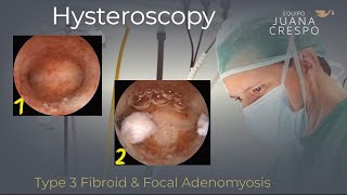 Type 3 Fibroid & Focal Adenomyosis