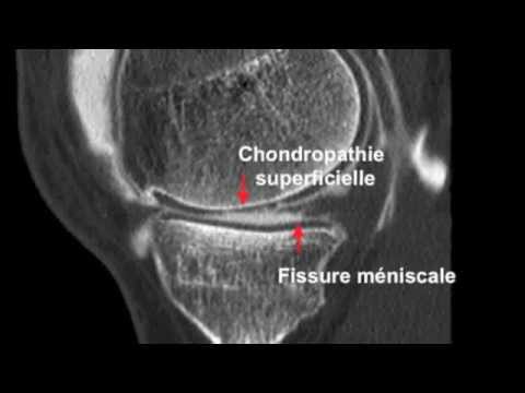 comment soulager chondropathie