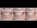 How-to Whiten your teeth with Hydrogen Peroxide ...