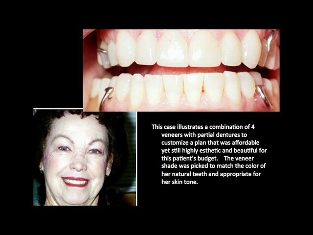 testimonia - Partial Dentures and Dental Veneers