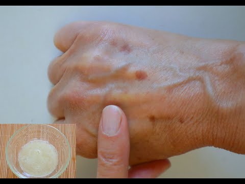 Entferne Hautflecken,Altersflecken,Muttermale,Warzen mit diesem Natürlichen Hausmittel 100% Effektiv