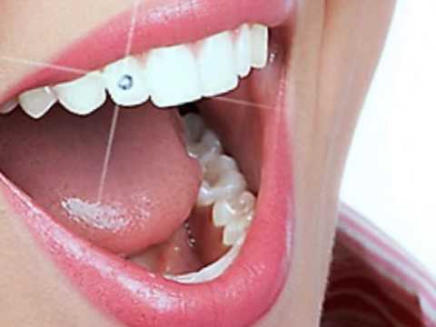 Dental jewellery