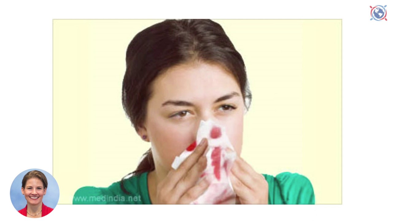 Patient Pulse: Managing Nosebleeds When You're on Anticoagulation