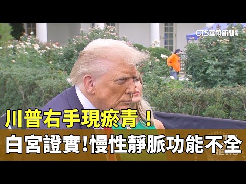 川普右手現瘀青！　白宮證實：慢性靜脈功能不全