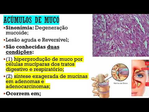 Patologia Geral - Degenerações Mucóide e Esteatose 17/04/2020