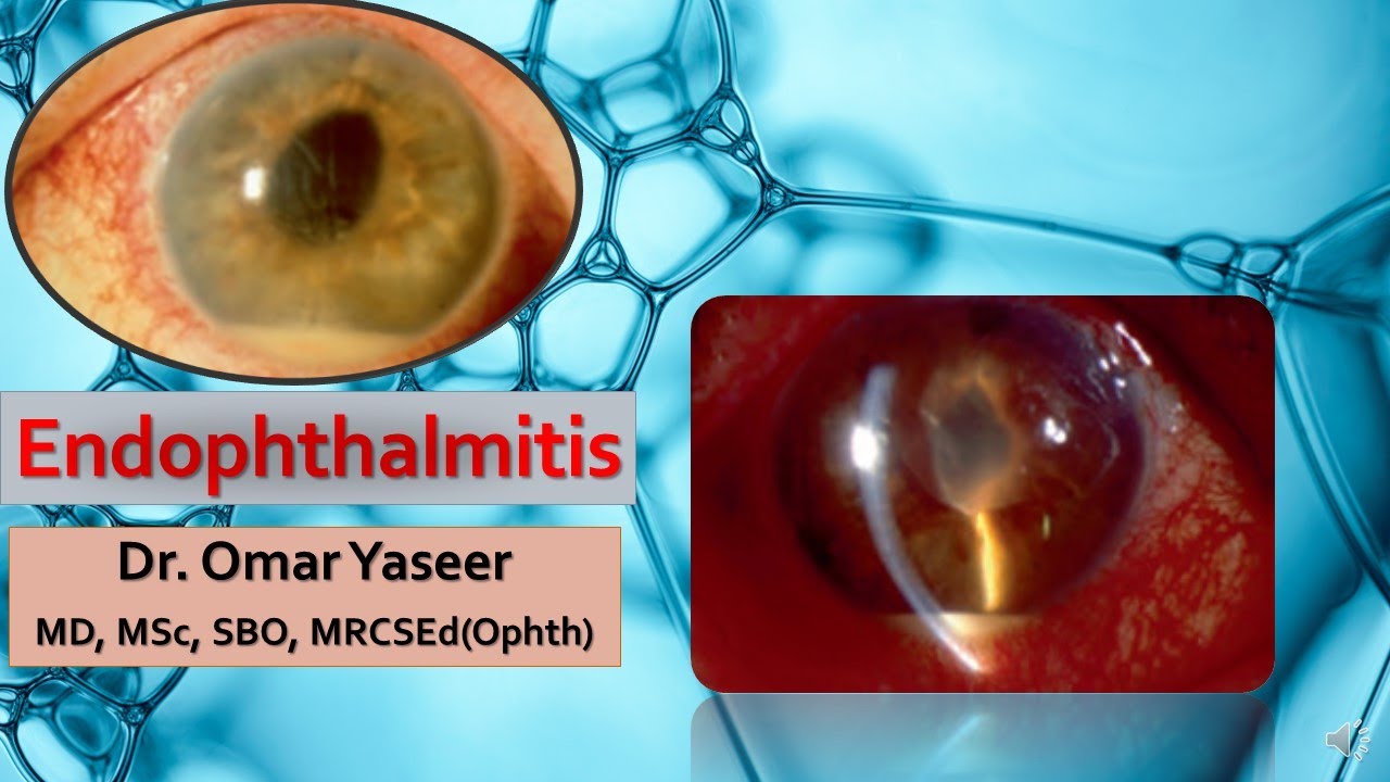 Pars Plana Vitrectomy
