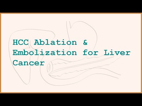 HCC Ablation and Embolization: Destroying Tumors