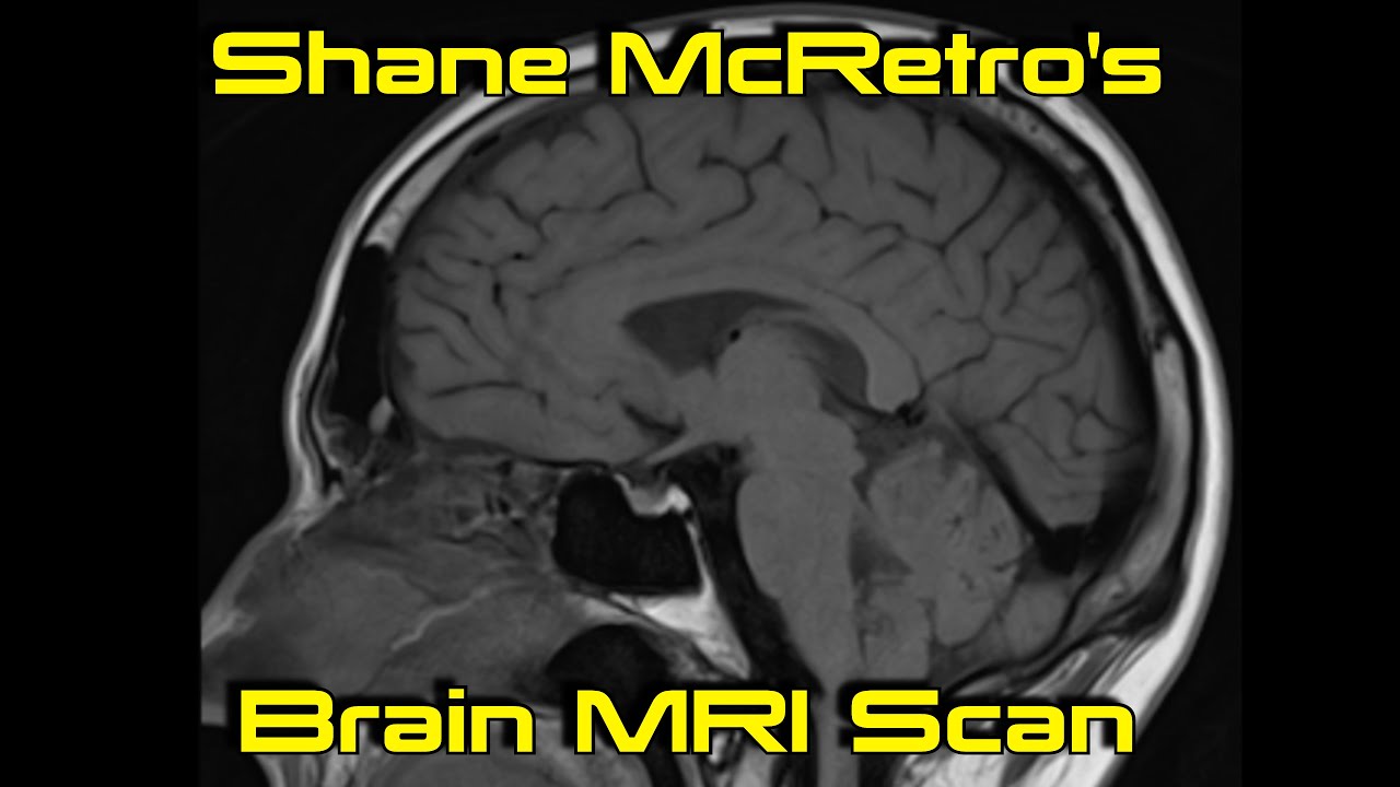 Shane's Brains! MRI Scan – September 2023