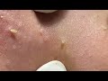 Acne Treatment Yen Nguyen Channel Official