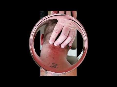 Schmerztherapie an der HWS... Prolotherapy