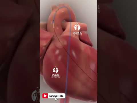 Animation of balloon angioplasty with stent procedure