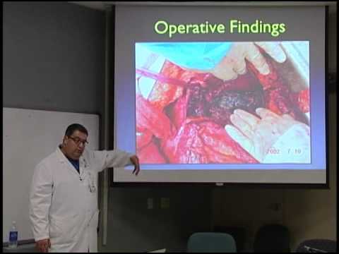 Pancreatic Debridement Techniques