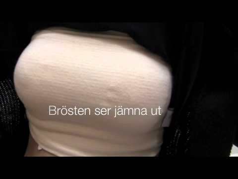 Bröstförstoring 365 g med bröstlyft efter 4 timmar på Nackakliniken Dr Gustav Aniansson