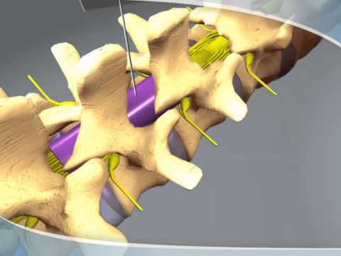 Epidural steroid injection