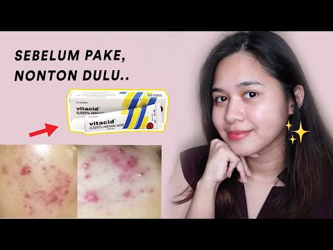 Cara Pake Vitacid Biar Gak Iritasi! Review Vitacid 0,025% Krim Jerawat