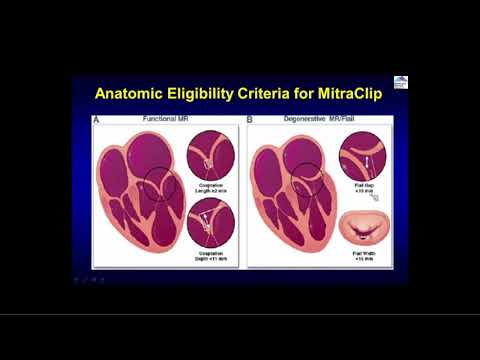Transcatheter Mitral Valve Therapy: Update