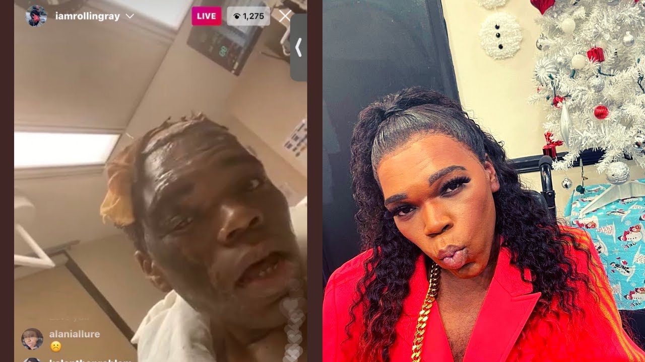 Rolling Ray’s wig catches fire!! He is now suffering with severe burns all over his body!!