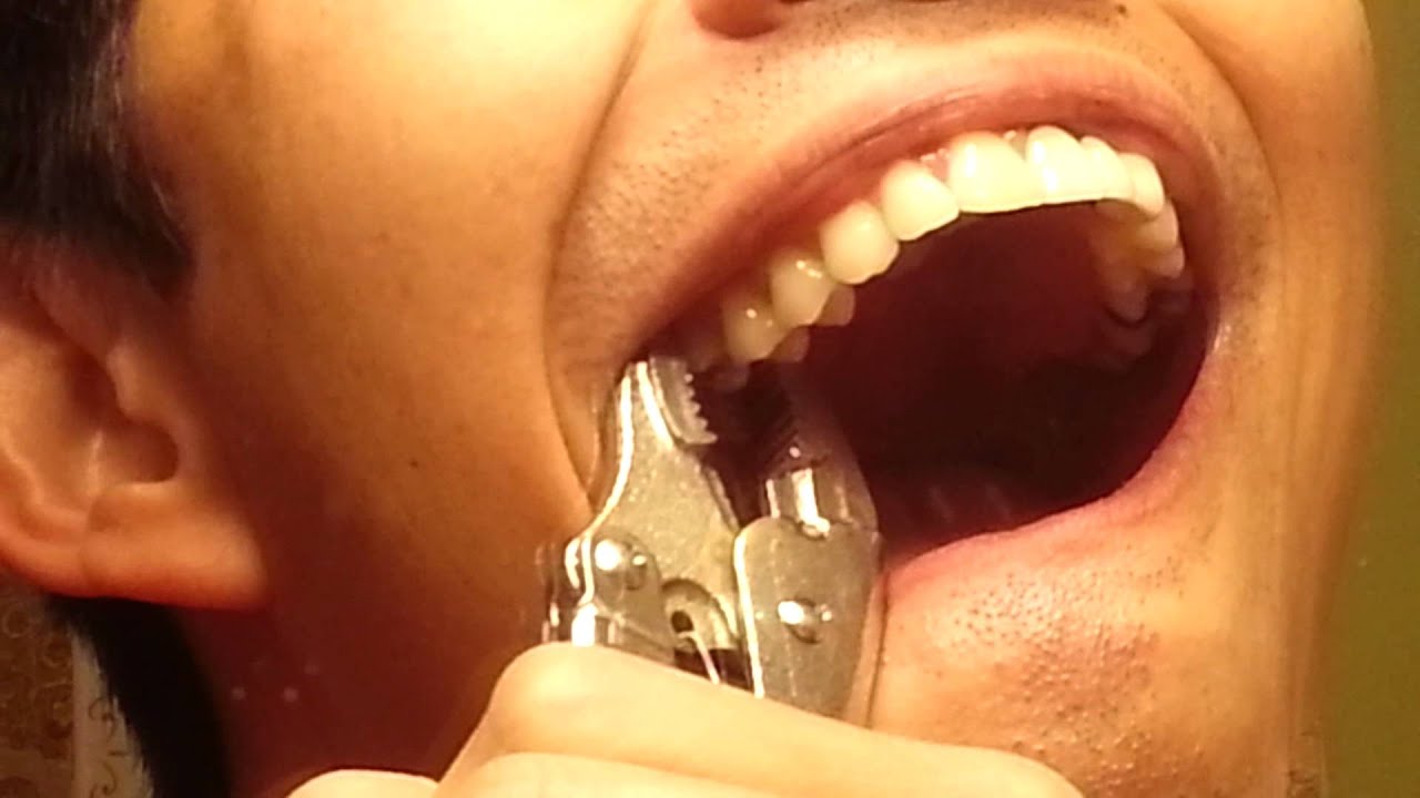 Pulled my own tooth using vise grips