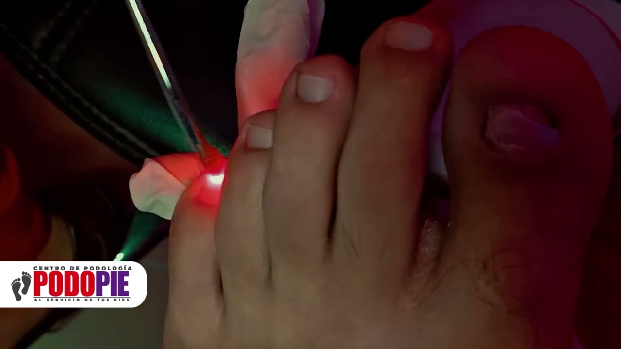 TRATAMIENTO CON LASER