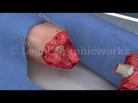 Leg Amputation Surgery 3D animation 
