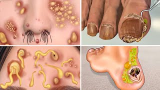 ASMR Ingrown Toenail & Blackhead Removal | Animated Acne Treatment