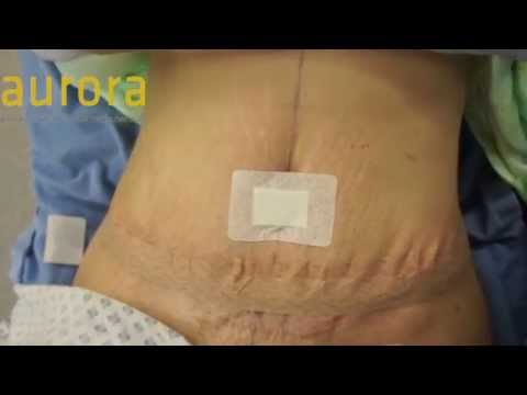 おなかのタック手術（腹筋形成術） - オーロラクリニック (Tummy Tuck Surgery (Abdominoplasty) - Aurora Clinics)