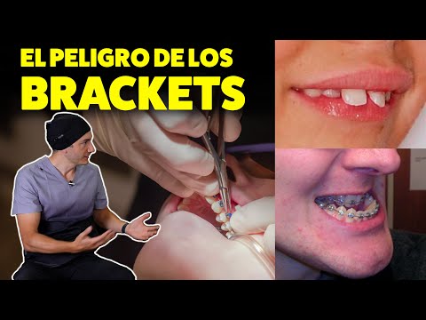 EL RIESGO #1 DE PONERTE BRACKETS