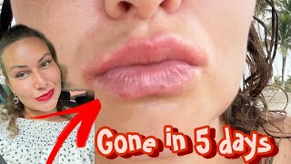 Angular Cheilitis gone in 5 days/Lip eczema,cracked lips red corners mouth SHOCKING FAST RESULTS