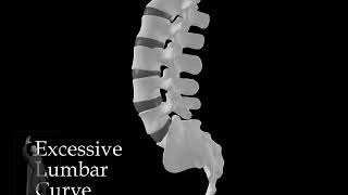 Excessive Lumbar Curve