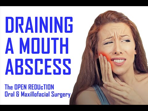 Draining A Mouth Abscess