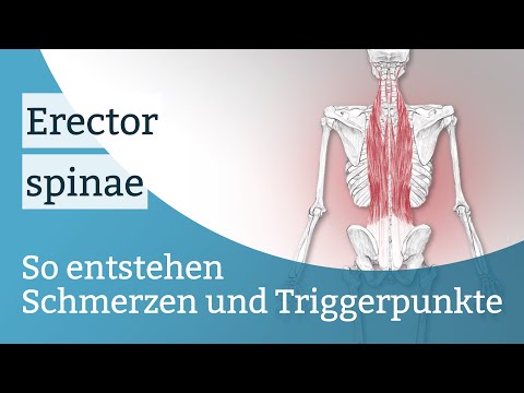 Erector spinae Schmerzen, Triggerpunkte und deren Aktivierung