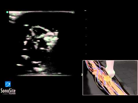 Trattamento dellosteoartrosi Mosca Provoca dolore al collo vicino alla parte posteriore della testa