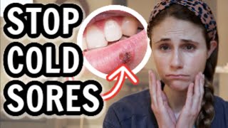 How to treat cold sores FAST| Dr Dray