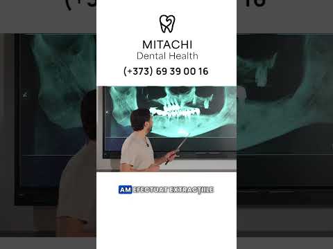 Tratamentul cu DANTURA FIXĂ este posibil și la pacienții cu DIABET