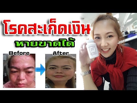 โคมไฟทางการแพทย์สำหรับโรคสะเก็ดเงิน Salitsilka โรคสะเก็ดเงิน