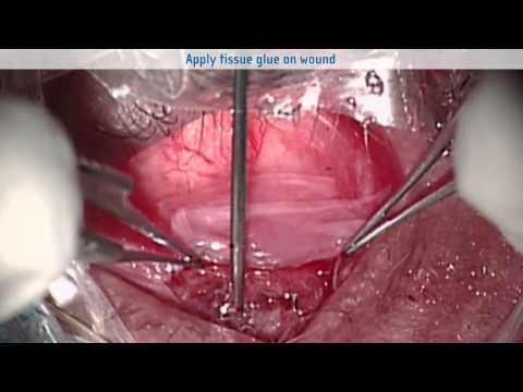 Video To Illustrate Eye Socket Reconstruction – Deepening Of The Inferior Fornix 