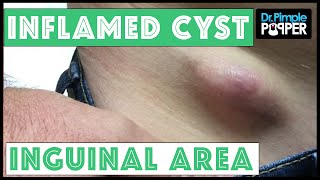 Inflamed Egg-Shaped Cyst Removed, Right inguinal area
