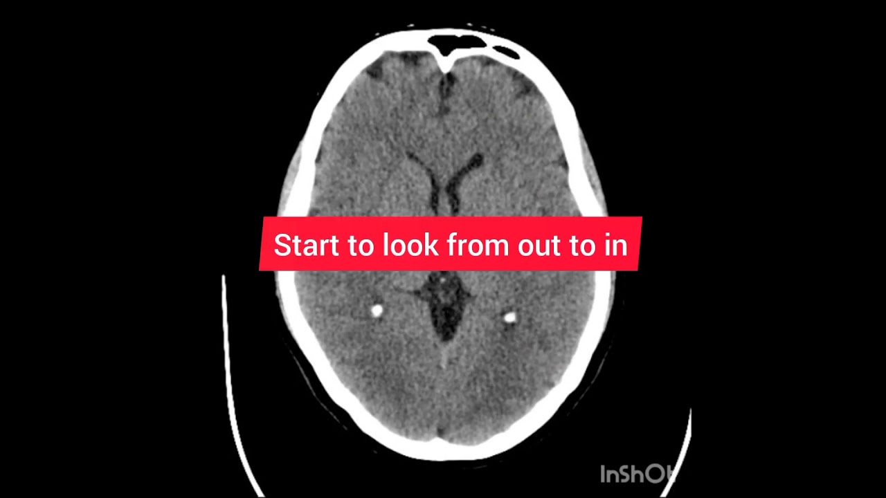 CT Brain #radiology made easy