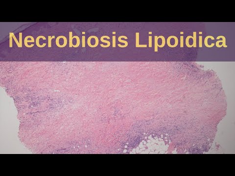 Necrobiosis Lipoidica Diabeticorum (NLD) - Pathology mini tutorial
