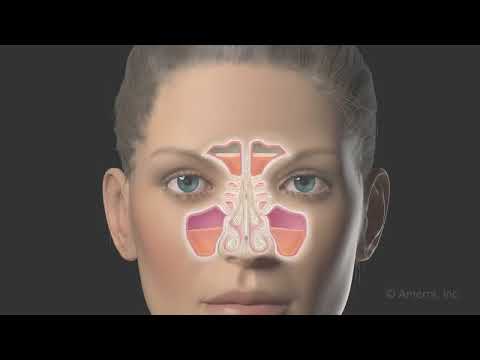 Functional endoscopic sinus surgery (FESS) - 3D animation Video