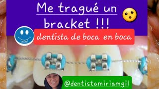 Me tragué un bracket !!!