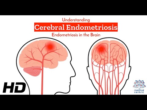 Thyroglossal Duct Cyst Causes Signs and Symptoms Diagnosis and Treatment