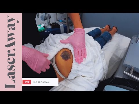 Laser Tattoo Removal LIVE Session at LaserAway