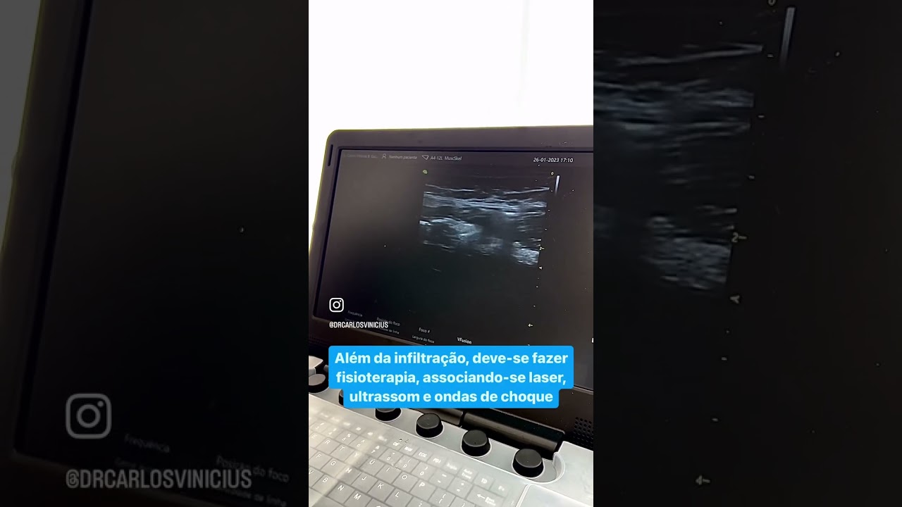 Tratamento de lesão muscular grau II na coxa (músculo semimembranoso)