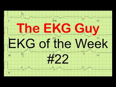 EKG/ECG of the Week #22 | The EKG Guy - www.ekg.md