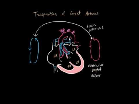 Transposition of Great Arteries