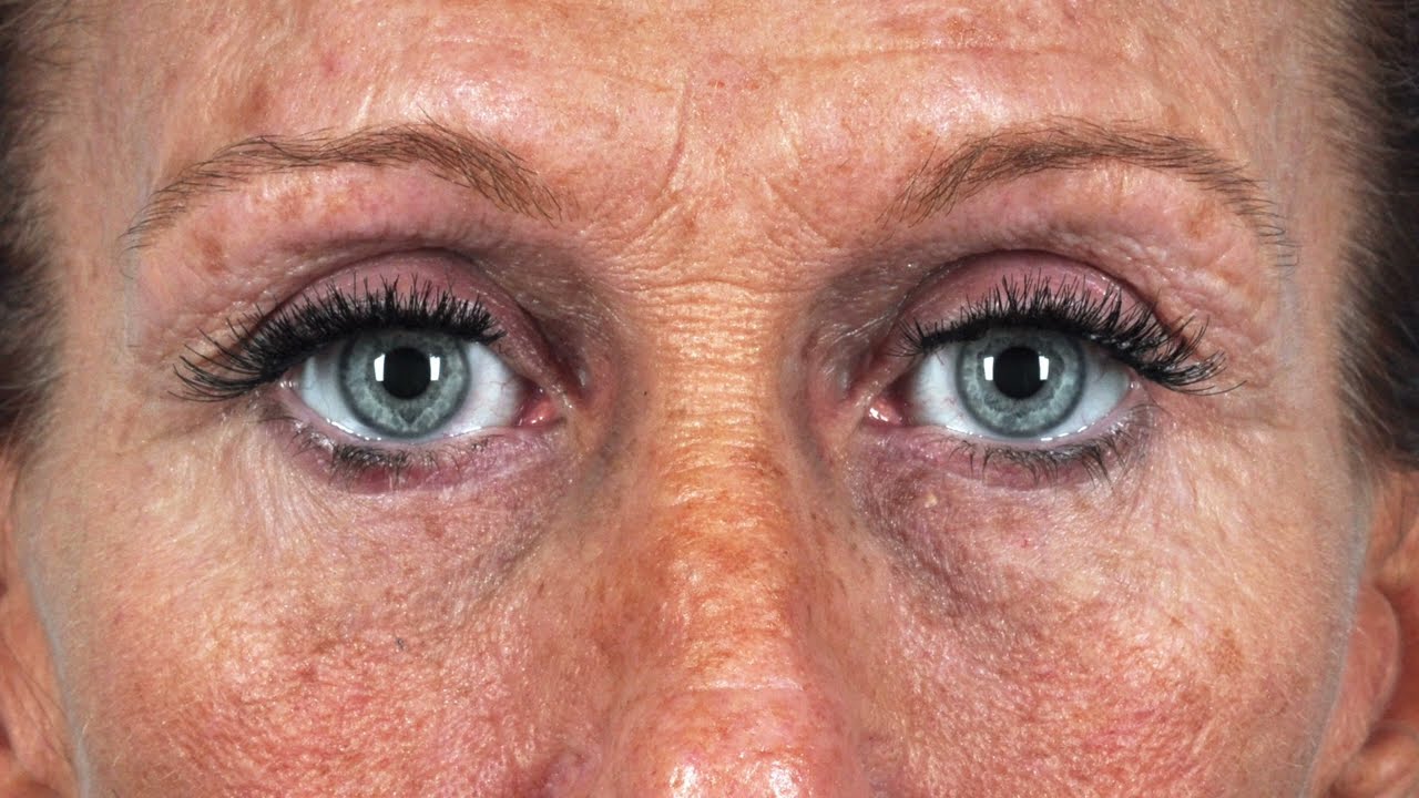 Eyelid Surgery Virginia Beach